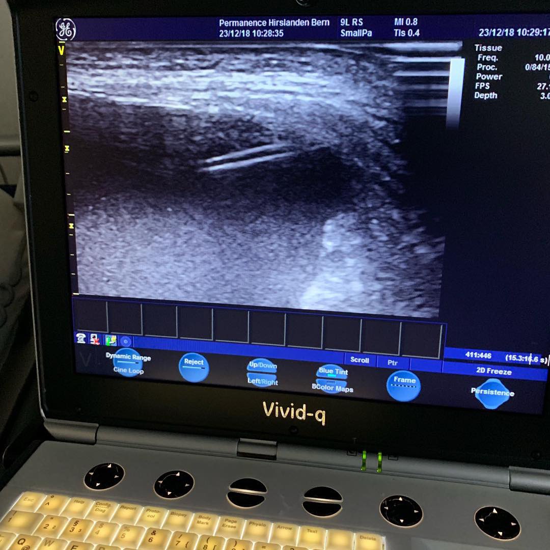 SportklinikBern's tweet photo. Today emergency room service for x-mas with ultrasound guided Aszites puncture (5.7l)... no muscle injury today...🧐 I ❤️ ultrasound- even the vivid-q...😉 #ultrasoundguidedpuncture #aszites #pocus #ershift #emergencyroom #xmas https://t.co/OGNW0xK0TM