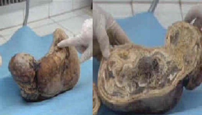 Allah T A Cree Reflechis Le Lithopedion Est Un Fœtus Issu D Une Grossesse Extra Uterine Non Arrivee A Terme Et Qui Est Mort Sans Avoir Ete Expulse Grace A Allah Il S Ensuit