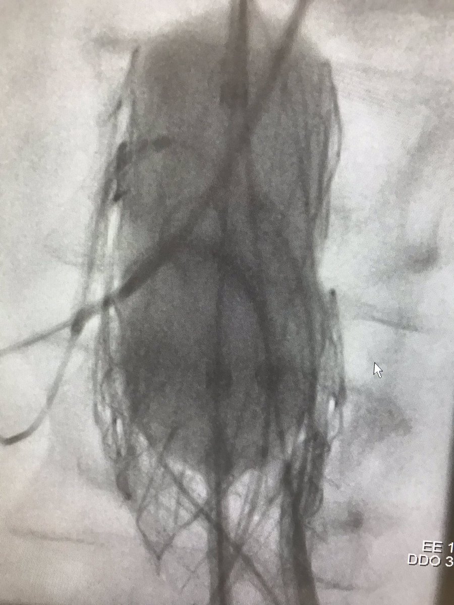 cfbechara's tweet photo. 85 yr old with ovation, Palmaz stent and gore limbs distally. #unitedstents 😬Comes in distress with type1A endoleak and expanding aaa and hypotension. Treated quickly with 2 fens using a cook cuff #doitrightfirsttime. @LoyolaVascular 💪🏼 https://t.co/yhCfdBI5nY