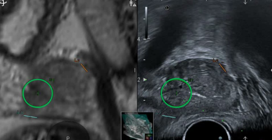 driuliaandras's tweet photo. Contralateral lobe systematic biopsy could safely be avoided in pts with PIRADS 5 during MRI-TRUS fusion guided prostate biopsy according to our experience @drnicolaecrisan @drkadula @emancata #ProstateCancer #prostateMRI 
https://t.co/mWZIVZ6Aox https://t.co/ClD5mMa4Qz