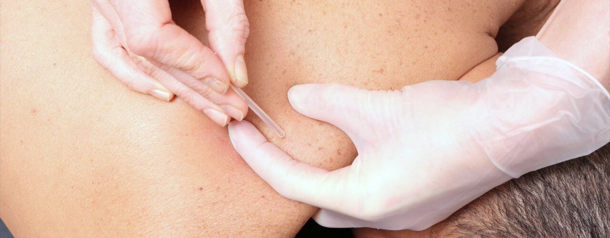 You may have heard of dry needling, but do you know the benefits it can have for athletes? One benefit is the reduction of delayed onset muscle soreness so that you can keep on pushing forward with you athletic performance! Learn more here:

ksspt.com/physical-thera…