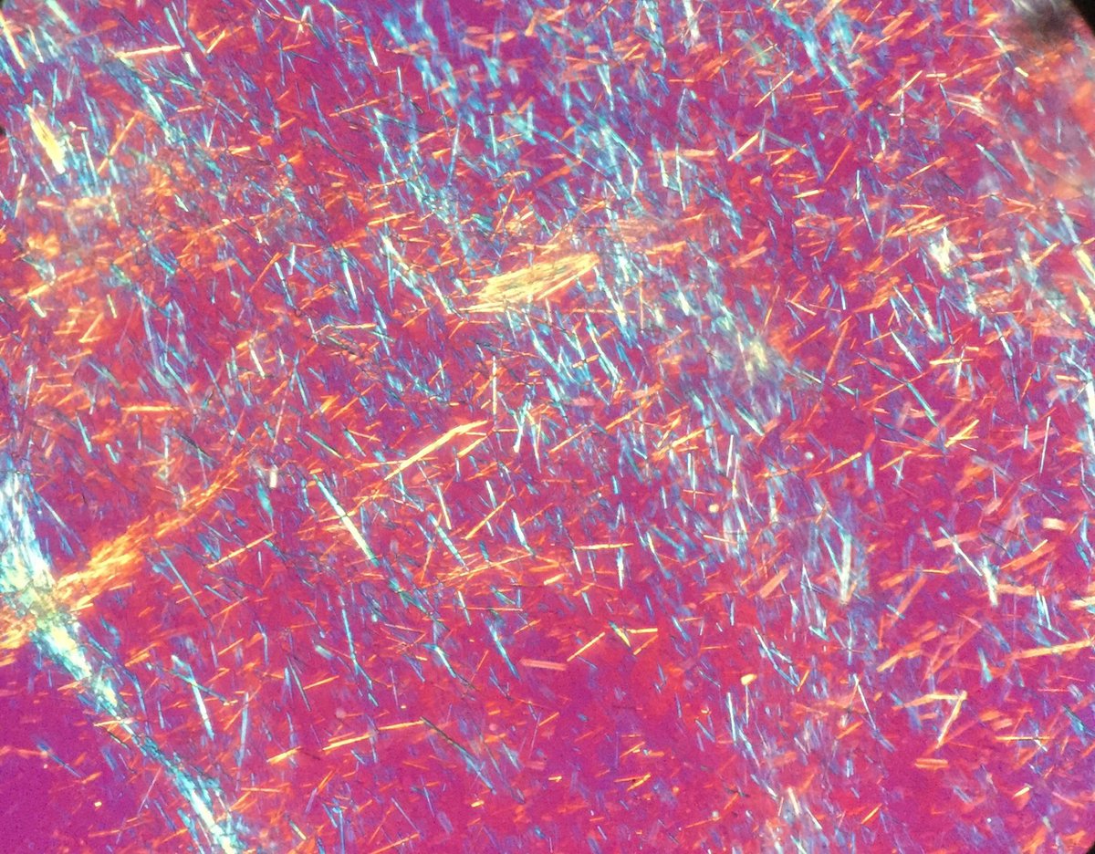 Gout crystals under polarized light. #pathart, image size:1200x936