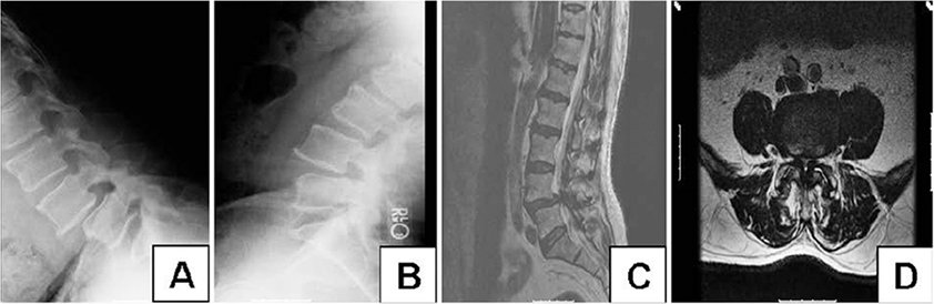 #FreeArticle: Randomized controlled trials for degenerative lumbar spondylolisthesis: which patients benefit from lumbar fusion? thejns.org/spine/view/jou…