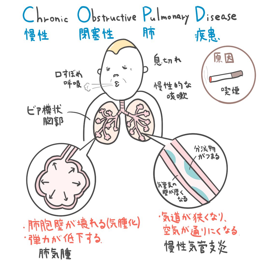 ゴロ 解剖生理イラスト در توییتر イラストで分かる 慢性閉塞性肺疾患 Copd わりと試験で出るところ