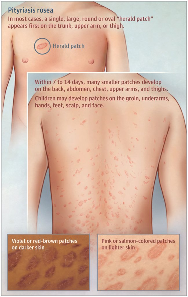 pityriasis rosea christmas tree pattern