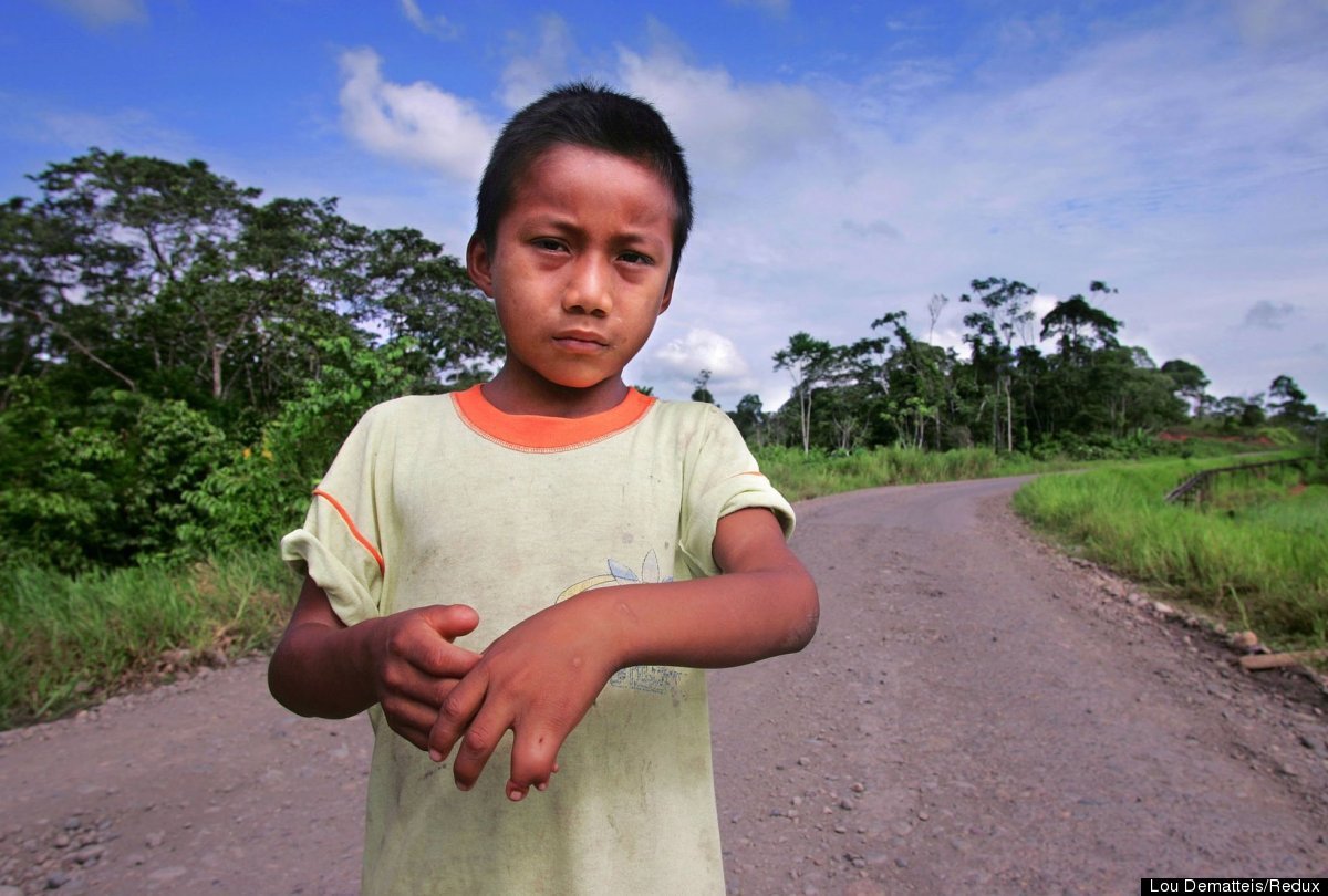 SDonziger's tweet photo. Jairo Yumbo, age 9, was born with a birth defect after his mother was exposed to @Chevron's toxic oil waste in the community of Rumipampa in Ecuador's Amazon. Chev refuses to comply with orders from 4 courts that it remediate the contamination. @Lenin @juanseroldan @rogerwaters https://t.co/Po1MAB6tYs