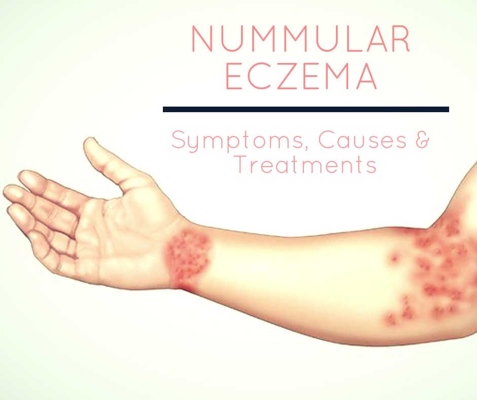 eczemaliving's tweet photo. #Nummular eczema, also known as #nummular_dermatitis or #discoid #eczema, is a chronic condition that #causes coin-shaped spots to develop on the #skin. Read nummular eczema #symptoms, diagnosis, causes and #treatment options if you are affected.
https://t.co/rUPVPaNfSg https://t.co/6I4Ld3H4Oq