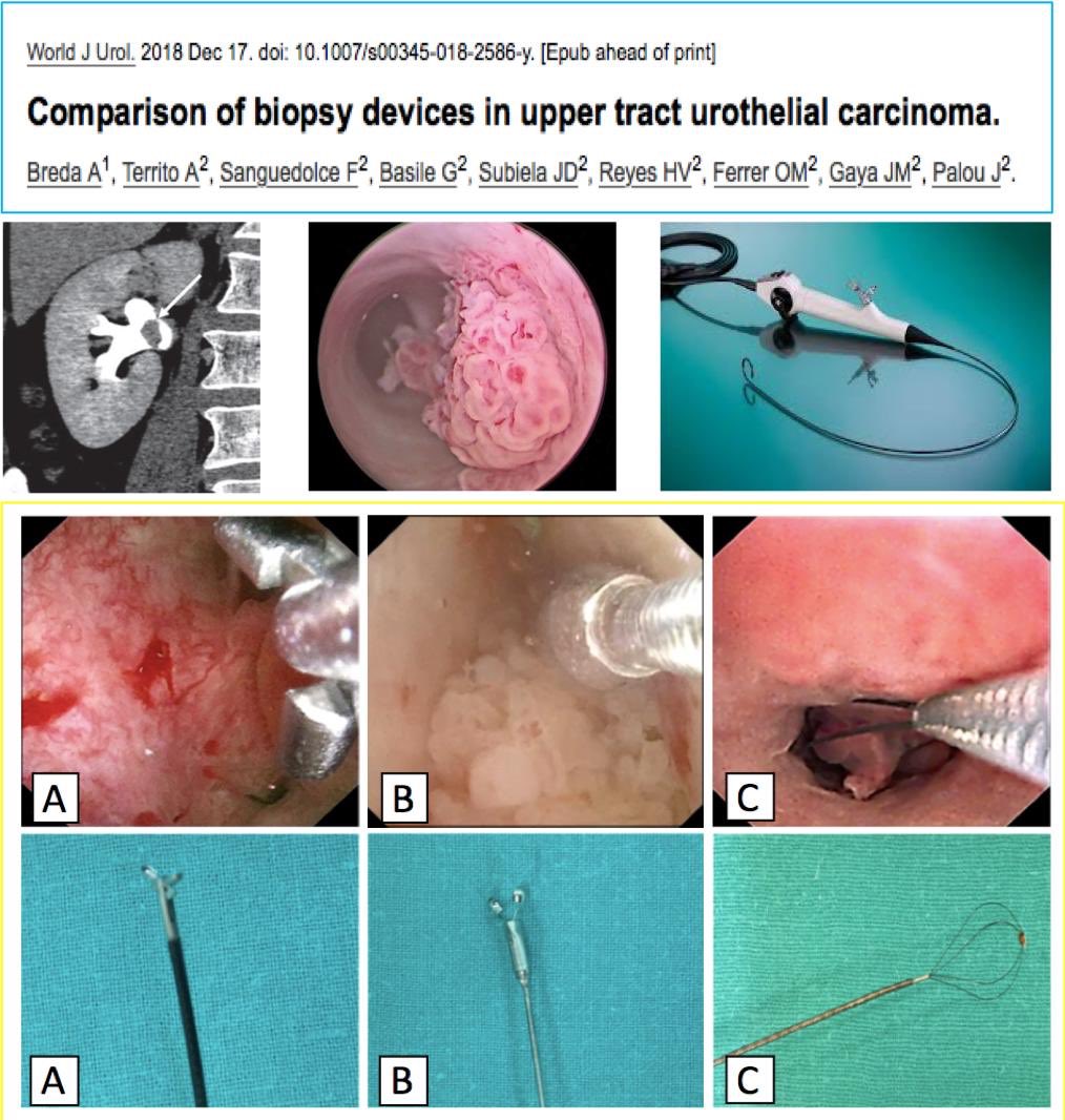 DrJM_Gaya's tweet photo. Size matters!!! At least in biopsies of UTUC. @FPuigvert @AlbertoBreda1 @joanfundi https://t.co/lThgjrOs8n