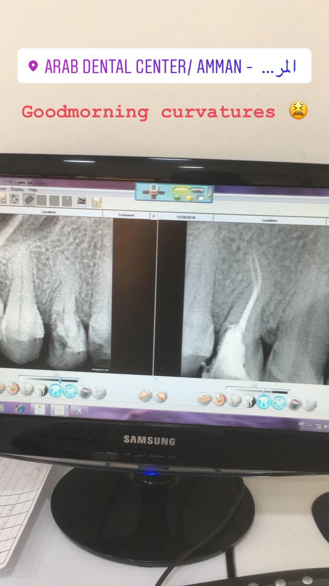 al_heresh's tweet photo. Goodmorning curvatures #endodontics #protaperGold @BetterEndo @DentsplySirona @arabdentaljo
Always always with severly curved roots use manual file only tell k file 20 then rotary if needed ! Single cone obturation with bioceramic sealer ! https://t.co/tGkEIWPAGP