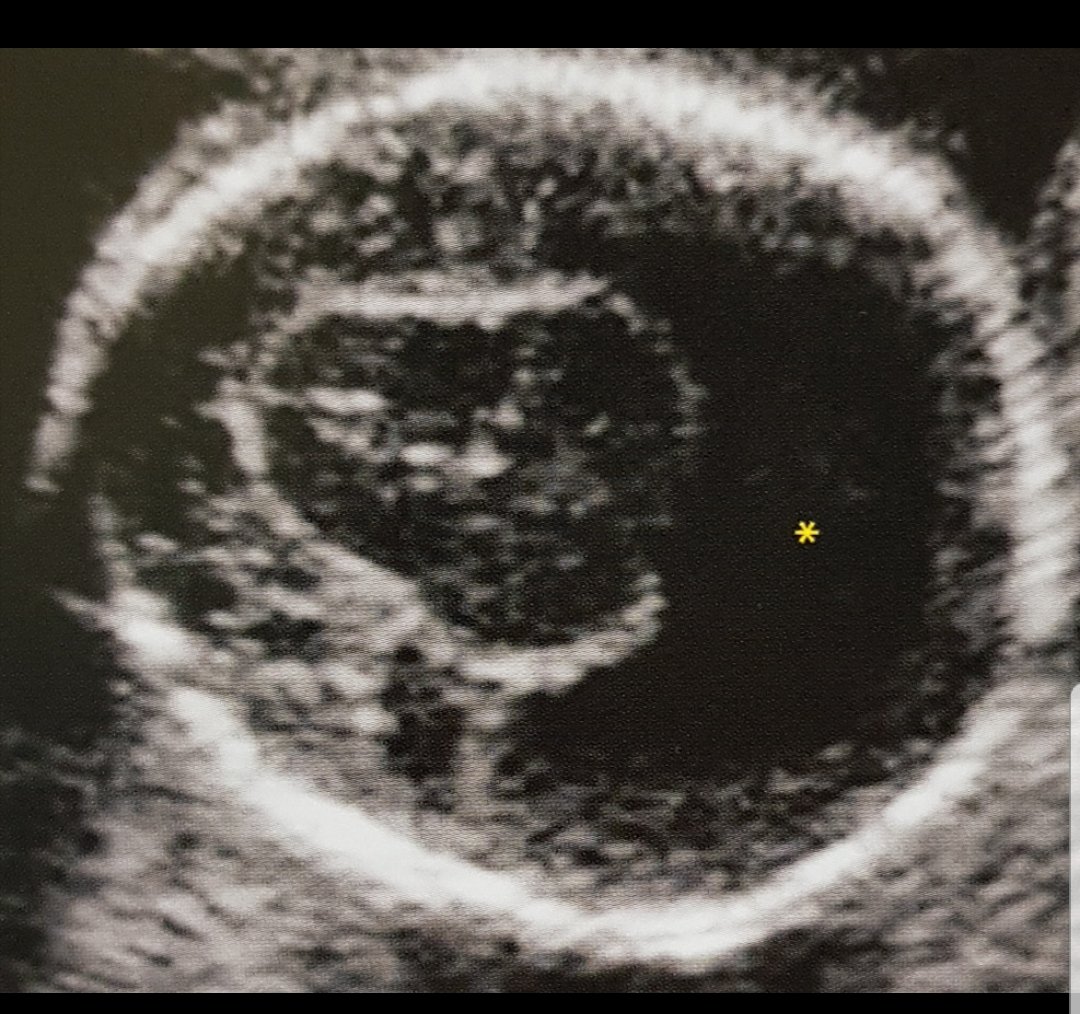 SignsRadiology's tweet photo. 》MONOVENTRICLE Sign (or "Absent Butterfly"). 🦋
DDx: Alobar Holoprosencephaly! https://t.co/G1zD3NC9be