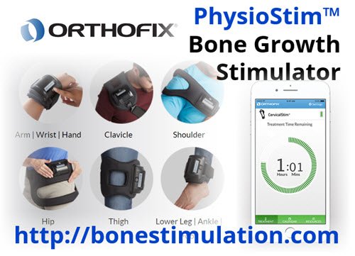 Orthofix Bone Growth Stimulator For Hip