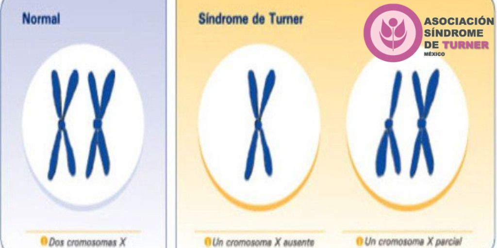 turnermexico's tweet photo. Llamamos "mosaicismo" a la a presencia de más de un patrón de cromosomas en una persona en estas niñas pueden presentarse menos características de ST que las niñas a cuyas células les falta por completo un cromosoma X, aunque esto también las hace blanco de un diagnóstico tardío. https://t.co/TLd4siJ6dU