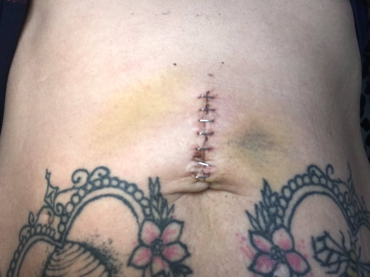 Hernia 4 3/4! Apparently there was “no hernia, trimmed the mesh” that’s all I know from my surgery 5 days ago! This black bruise is in the exact spot of my pre op pain! Hospital notes requested! Follow up in 5 weeks @MeshCampaign #herniasurgery #hernia #mesh #meshie #meshwarrior