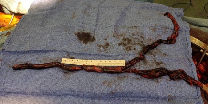 2Scottish's tweet image. Patient with past unprovoked VTE off warfarin for 3 weeks, but decided to start back.  One day later, experienced acute SOB, SaO2 in 70s on r.a.  RV not looking great.  This monster was removed by surgical embolectomy.  Extubated to room air within 12 hrs. @PERTConsortium