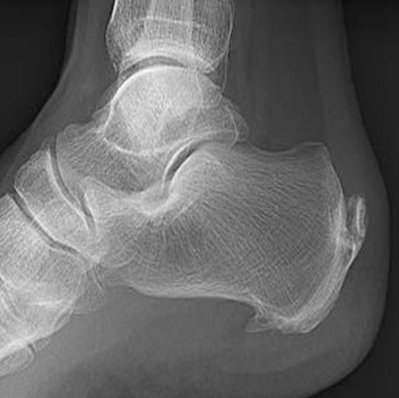 agitpopworld's tweet photo. @TheOnion PHANTOM BONE SPURS Haunt Patients For Decades.

Today @NYTimes suggested President Trump avoided fighting in Vietnam after he was diagnosed with *phantom* bone spurs. 

In response, The White House released a report alleging #PhantomBoneSpurs plague sufferers for years. https://t.co/YQw0Gn8UeO