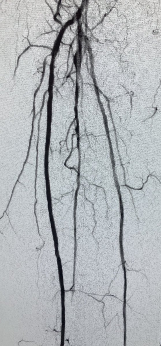 CarlosGuevaraIR's tweet image. #CLIFighters Non-healing heel and toe ulcer, being offered amputation, after revascularization of PT, plasty AT and peroneal, blush at the wound and bleeding #MyLegMyLife @ZagumBhatti @roblookstein @kmadass @LessneVIR @keithppereira @JVIRmedia @Saukalaka @BostonPIMedEd