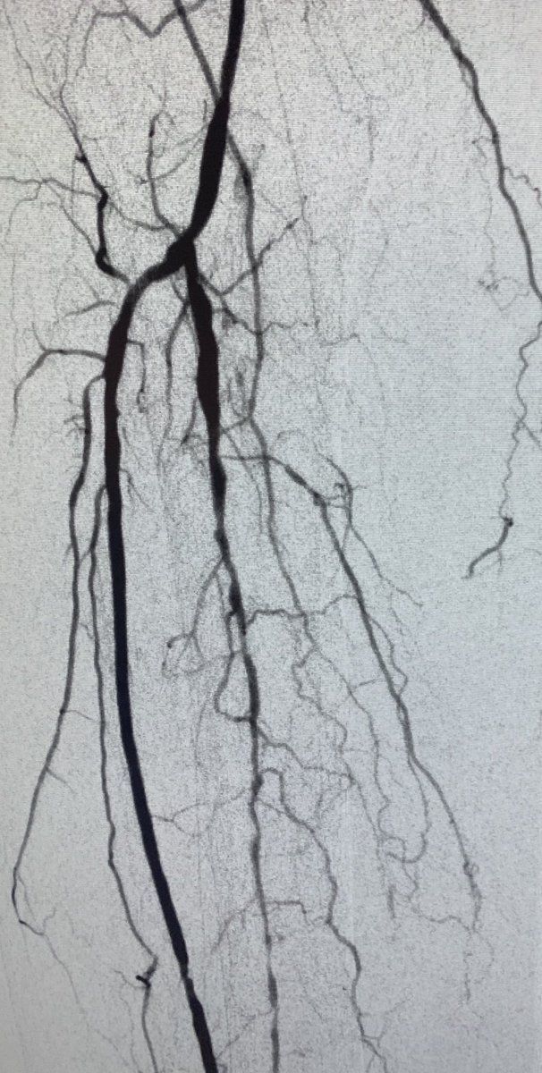 CarlosGuevaraIR's tweet image. #CLIFighters Non-healing heel and toe ulcer, being offered amputation, after revascularization of PT, plasty AT and peroneal, blush at the wound and bleeding #MyLegMyLife @ZagumBhatti @roblookstein @kmadass @LessneVIR @keithppereira @JVIRmedia @Saukalaka @BostonPIMedEd
