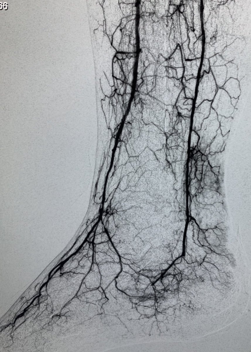 CarlosGuevaraIR's tweet image. #CLIFighters Non-healing heel and toe ulcer, being offered amputation, after revascularization of PT, plasty AT and peroneal, blush at the wound and bleeding #MyLegMyLife @ZagumBhatti @roblookstein @kmadass @LessneVIR @keithppereira @JVIRmedia @Saukalaka @BostonPIMedEd