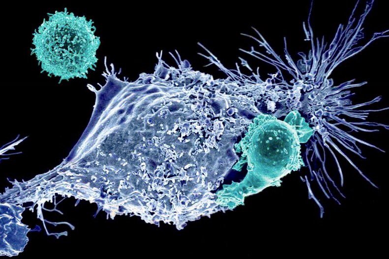 DnnHealth's tweet photo. FDA approves revolutionary cancer drug CAR-T therapy for patients w/ acute lymphoblastic leukemia (ALL) and Australia for diffuse large B cell lymphoma (DLBCL) Immune cells trained to kill cancer by extracting them, genetically re-engineering, then infusing back into the body. https://t.co/mnGtNZmt7e