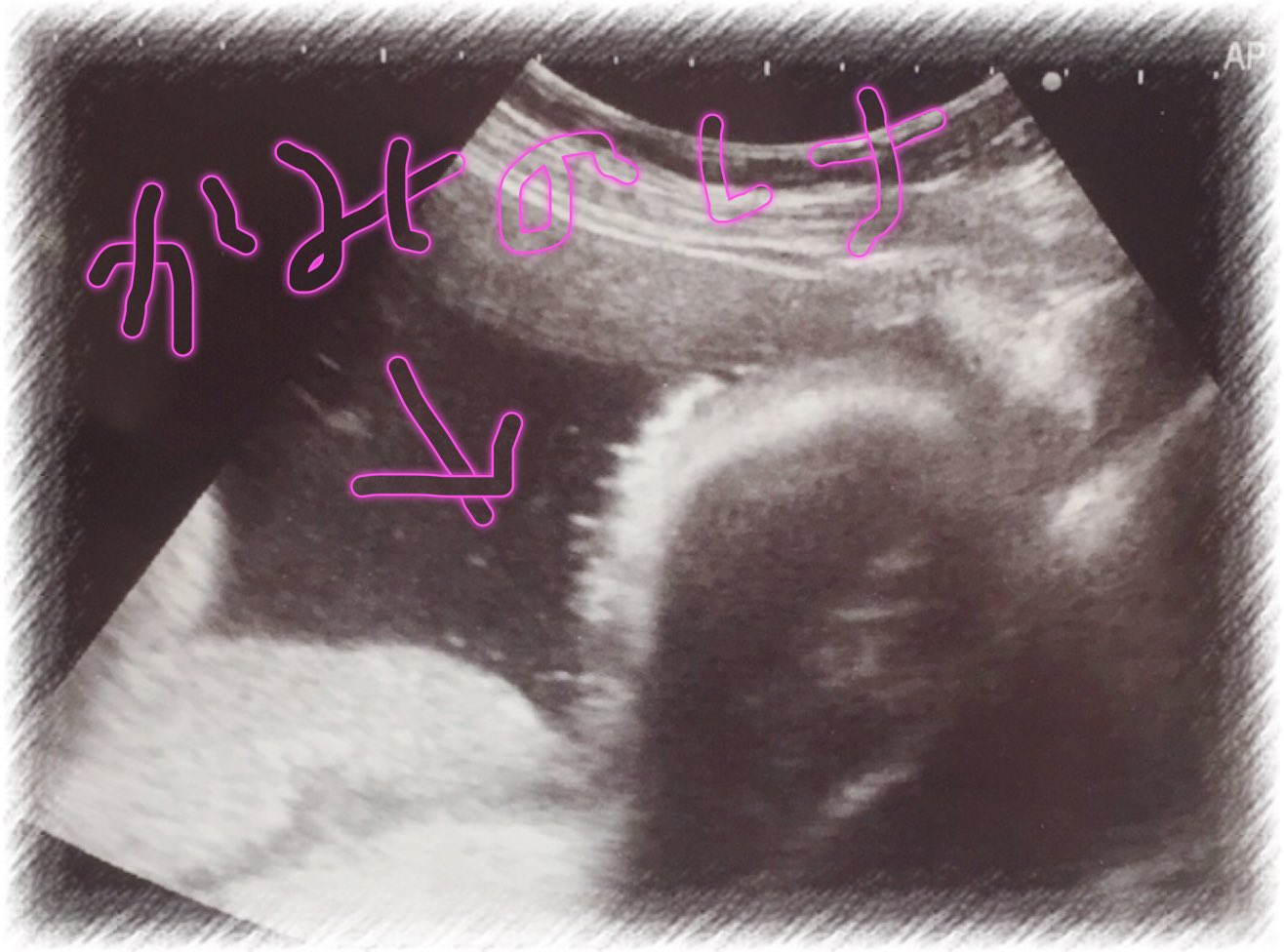 大森真理子 11 19 土 渋谷jz Bratワンマンライブ 35週目の妊婦健診行ってきました 嫌いな採血 三本コース 頑張った 笑 順調だそうですっ 20gちょっとまで大きくなりました 母も大きくなりましたうふ 笑 明日から臨月突入 後期 大森真理子 11 19 土 渋谷jz Bratワンマンライブ 35週目の妊婦健診行ってきました 嫌いな採血 三本コース 頑張った 笑 順調だそうですっ 20gちょっとまで大きくなりました 母も大きくなりましたうふ 笑 明日から臨月突入 後期