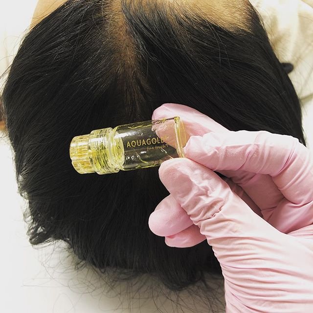 @aquagoldft allows u to use the products u want, in the amounts u need, to address the skin concerns of your patients, including scalp treatments!
In the U🇺🇲? Signup for the AQUAGOLD® Prime Membership.
📷 @kosmedlarvik
#aquagoldfinetouch #microchanneling #medicaldevice