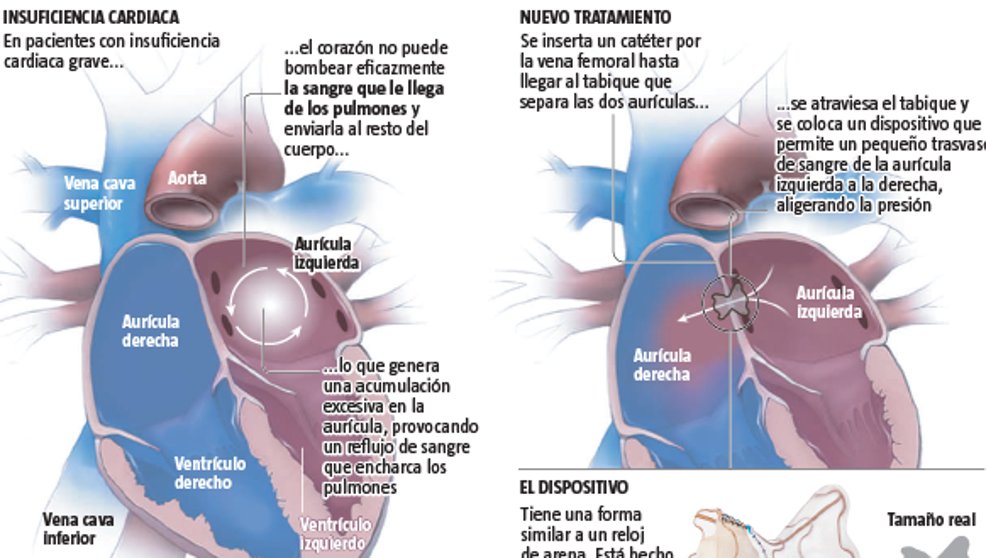 YoavKatz's tweet photo. Una nueva innovación médica desarrollada por israelíes - un dispositivo para el corazón que baja la presión y disminuye el riesgo grave de muerte.
Trabajando para mejorar el mundo y la vida de las personas alrededor del mundo.
https://t.co/odRYpc0V8k https://t.co/WL4cNQgdpA