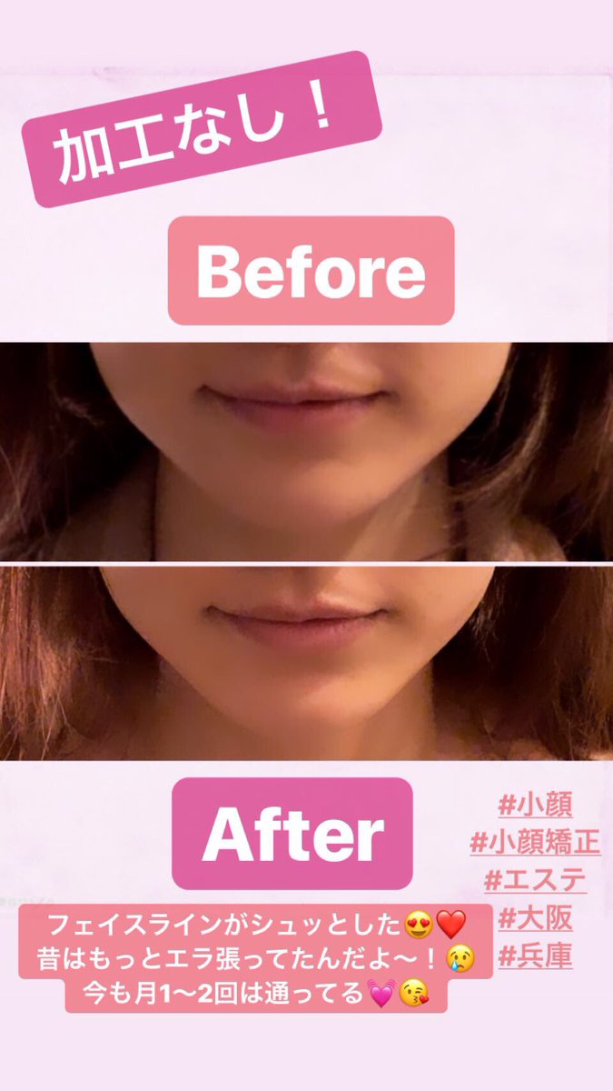 Sachi 𝒮𝒶𝒸𝒽𝒾𝓀𝑜 𝒰𝓂𝑒𝓂𝓊𝓇𝒶 Twitterren オススメの小顔矯正 お正月明けに是非 笑 加工なしのビフォーアフターも載せたよ 1回で効果が出るから本当にオススメ 頭蓋骨から小さくしていくのと 首も細く長くなるっ 凝り固まってる人は 岩盤 Sachi 𝒮𝒶𝒸𝒽𝒾𝓀𝑜 𝒰𝓂𝑒𝓂𝓊𝓇𝒶 Twitterren オススメの小顔矯正 お正月明けに是非 笑 加工なしのビフォーアフターも載せたよ 1回で効果が出るから本当にオススメ 頭蓋骨から小さくしていくのと 首も細く長くなるっ 凝り固まってる人は 岩盤