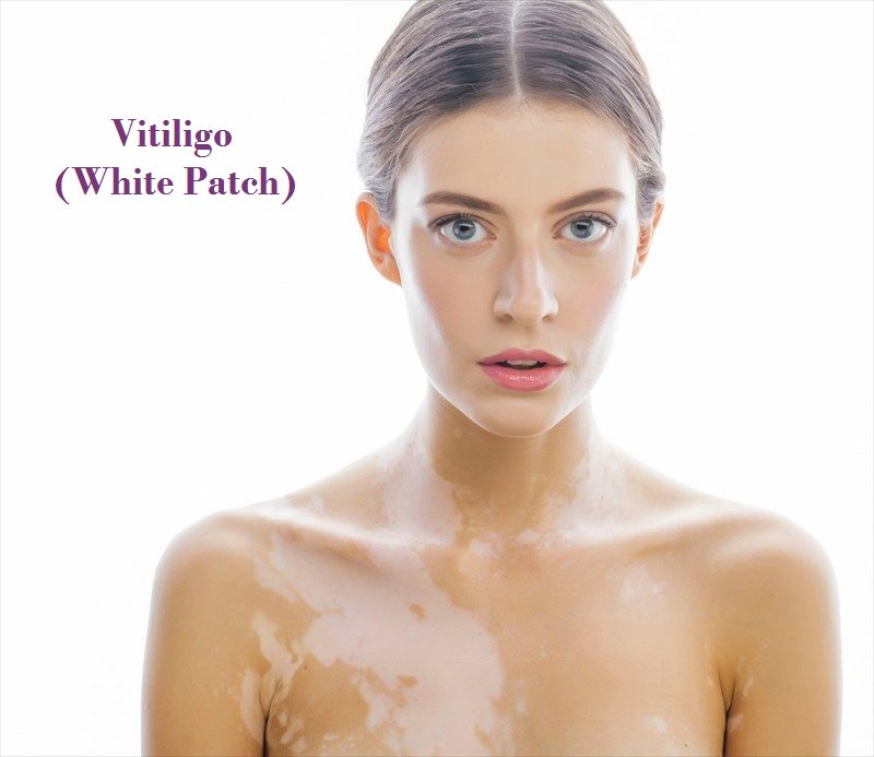 medispajaipur's tweet image. Vitiligo (White Patch) Treatment with Cosmetic Procedure at Medispa 
medispaindia.in/vitiligo-white…
#cosmeticsurgery #vitiligo #whitepatch