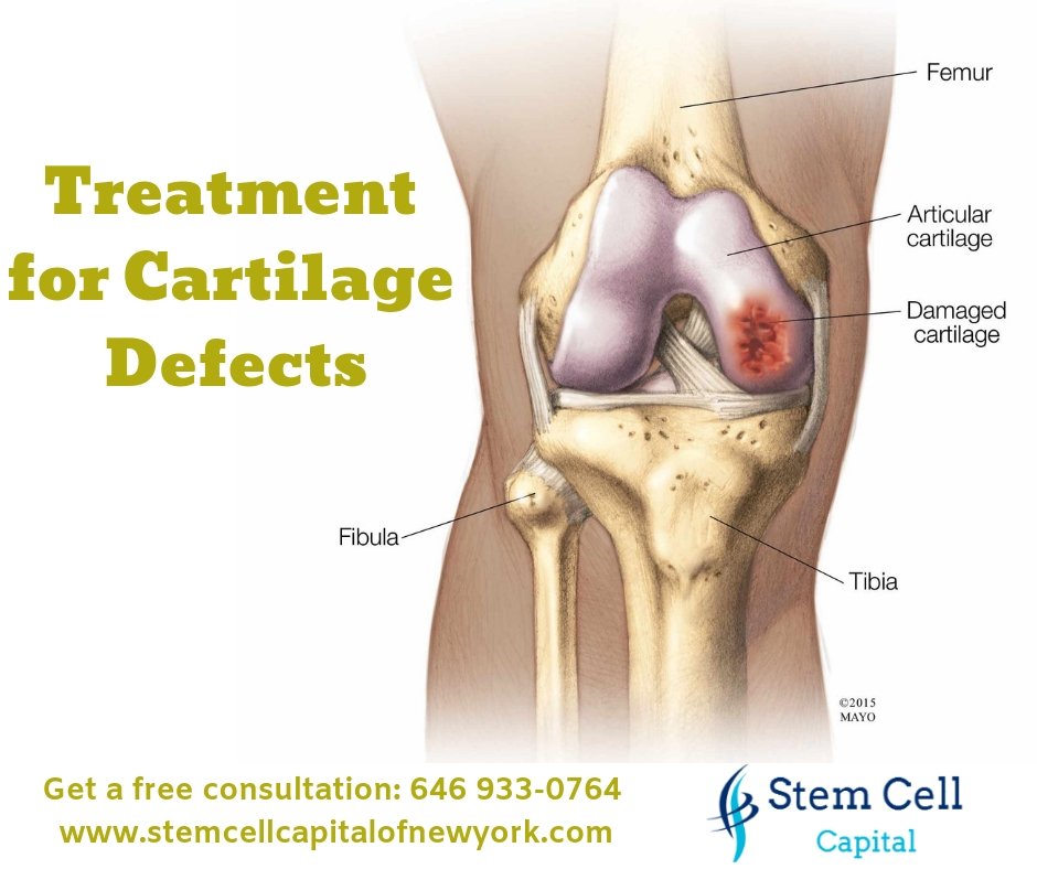 Ashleylrd's tweet photo. The cause of a #CartilageDefect can be due to trauma, osteonecrosis, osteochondritis, and other conditions.
Get More Details: https://t.co/iAHsEwq4Vi

#StemCellsTherapy #Knee #Injury #Movement #Pressure #NewYorkForever #MyFavoriteOneHitWonders #Maplewood #Bronx #California https://t.co/0ZeouBCHj1