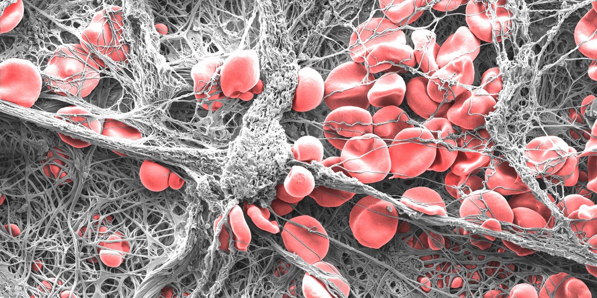 zeiss_micro's tweet photo. This image won the 1st prize in this year’s Images of Research Photography Competition run by the @UniversitySA . It shows a blood clot caused by a medical device for cardiovascular diseases. 
Dr Eli Moore gives insights into his research: https://t.co/lAxO4GEh6M https://t.co/cjpT3jGLVu