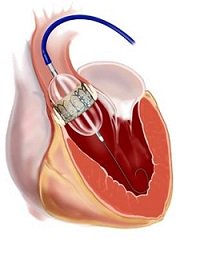 CRMjournal (@CRMjournal) on Twitter photo 2018-12-27 15:20:41 FREE ACCESS: Summary of the 2018 #Medicare Evidence Development & Coverage Advisory Committee (#MEDCAC) for #transcatheteraorticvalvereplacement by Toby Rogers, Jaffar M. Khan, J. James Edelman and @ron_waksman authors.elsevier.com/a/1YCrw5XJLGmu… FREE ACCESS: Summary of the 2018 #Medicare Evidence Development & Coverage Advisory Committee (#MEDCAC) for #transcatheteraorticvalvereplacement by Toby Rogers, Jaffar M. Khan, J. James Edelman and @ron_waksman authors.elsevier.com/a/1YCrw5XJLGmu…