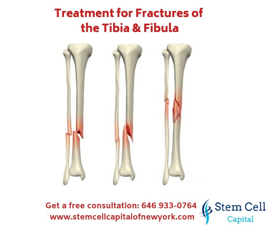 Ashleylrd's tweet photo. A #Fracture is a broken bone caused by a medical condition known as a pathological fracture.

Get Free Consultation: 646 933-0764
Website: https://t.co/iAHsEwq4Vi

#OrthopedicSurgery  #StemCells #NewYork #Treatment #Injury #Medecine #Emergency #TheInstagram #NYCClinics #Manhattan https://t.co/sA6dyV5VOl