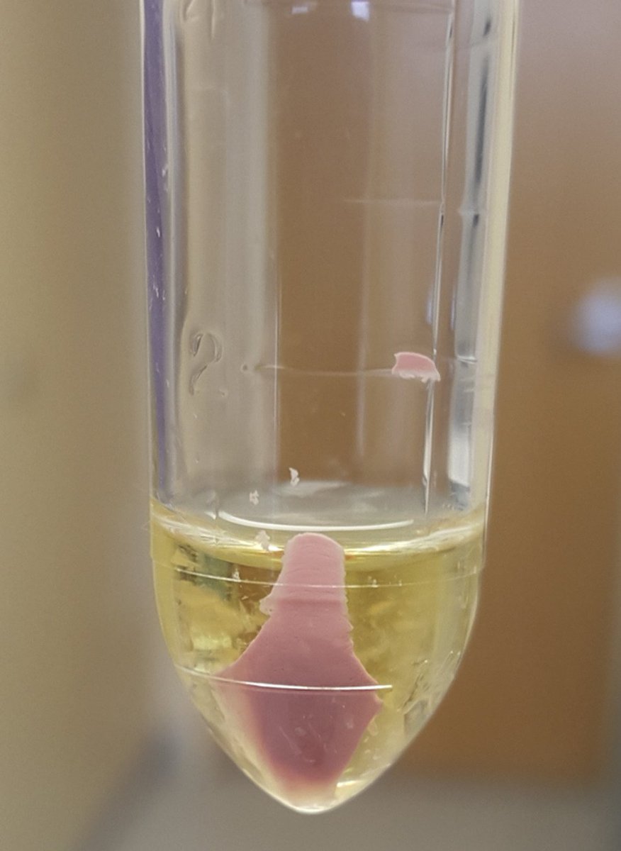 Pink Urine Syndrome
doi.org/10.1016/j.ekir…
<a href="/wakeforestmed/">Wake Forest University School of Medicine</a>