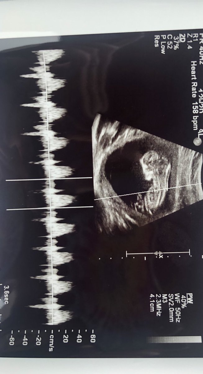 laynegelia's tweet photo. They got our baby waving on the ultrasound today! He/she was upside down and waving at us today 😁 3 weeks till we find out the gender! 💗💙 https://t.co/J42qQyMoji