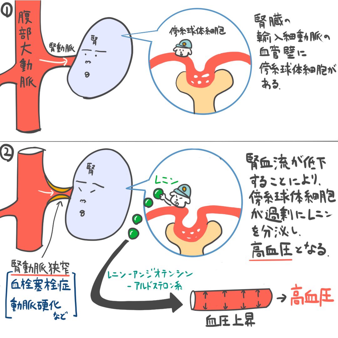 ゴロ 解剖生理イラスト Auf Twitter 2コマのイラストで分かる 腎血管性高血圧のしくみ