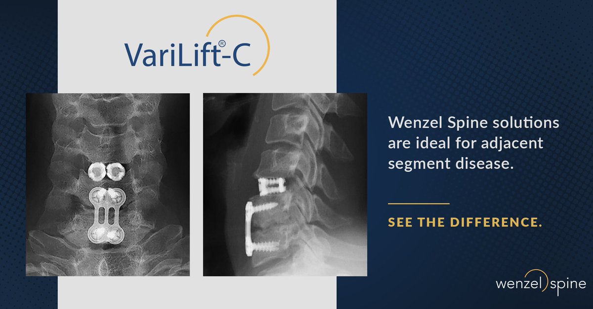 WenzelSpine's tweet photo. #simplifyspine https://t.co/8ozJNWbEA1