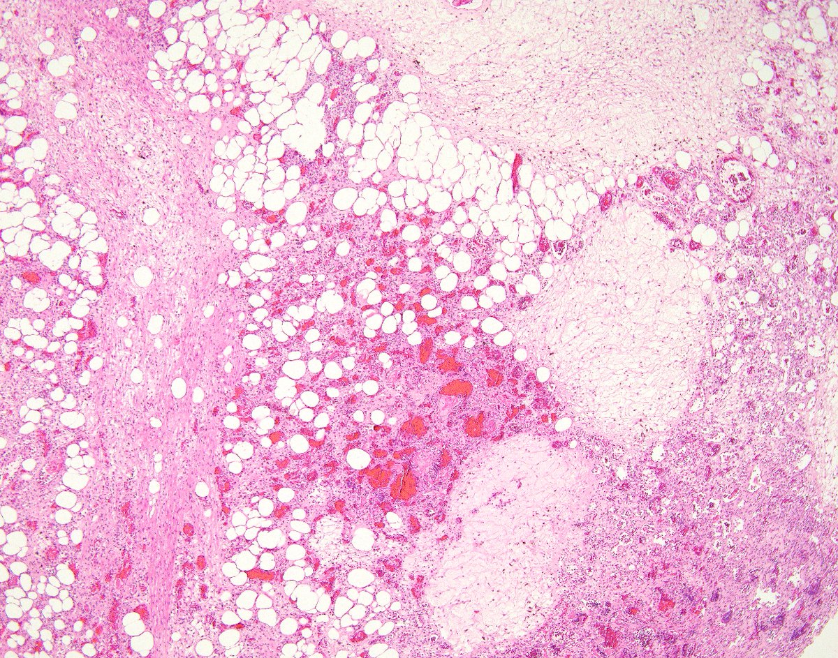 LizMontgomeryMD's tweet photo. Super lovely example of anastomosing hemangioma of kidney.  It even has extramedullary hematopoiesis and hyaline globules.  These tumors are so cute and can be foolers for angiosarcoma. https://t.co/I5N9xlWSvb