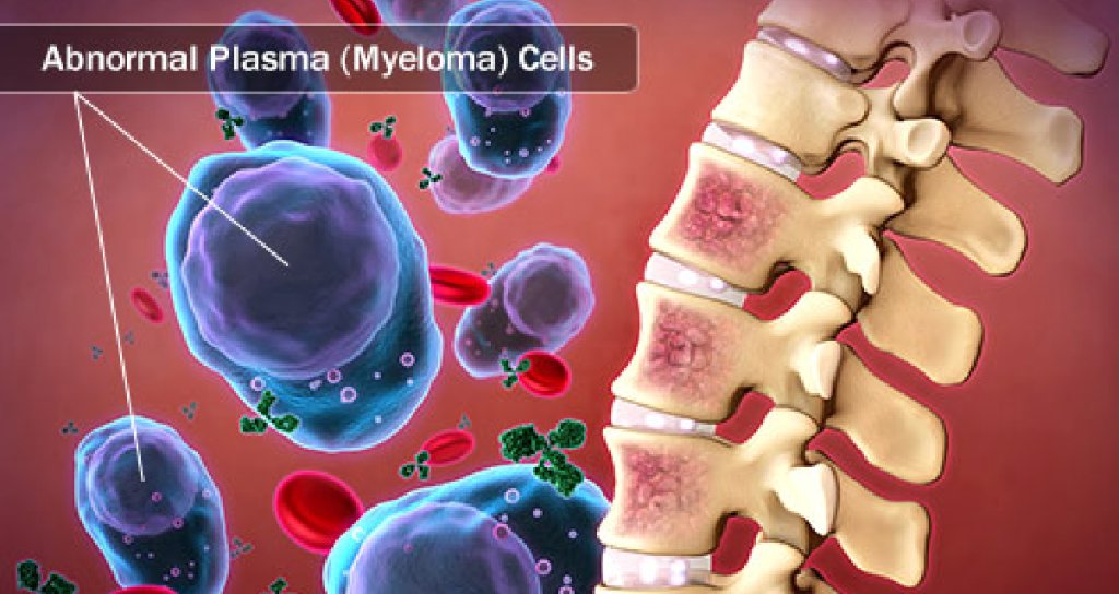 MedscapeOnc's tweet photo. 4 major developments on multiple myeloma. https://t.co/k0vSTRmoT0 #MMSM #AHS18 https://t.co/cUma8eEieB