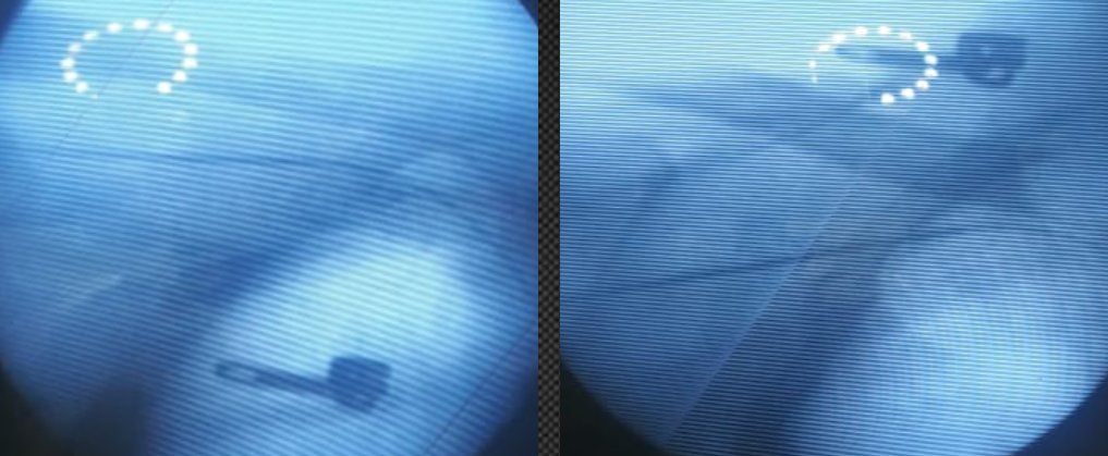 ALFIEEP1's tweet photo. #Epeeps #AxillaryFirst
Contribution from @FYang_EP to change my practice in 2018
Axillary puncture using caudal 35°.
Left pannel caudal 35°, right pannel AP. Look how in AP needle invades thorax, whereas in caudal 35°, always needle away from it. No dye needed never. Give a try. https://t.co/Tt1y2Pseqz