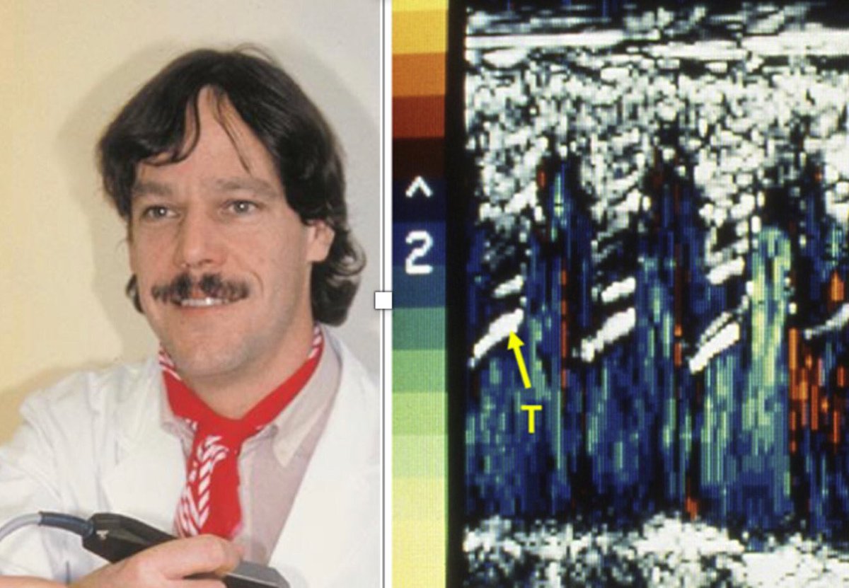 MAecocardio's tweet photo. OUR  #ECHOHISTORY : It's been 42 years since M. BRANDESTINI  (1970-Zurich)  combined M mode Echocardiography with color Doppler imaging (flow+ anatomy) ,thus ….ECHO-COLOR DOPPLER was born. https://t.co/v0t0GgfpLg
