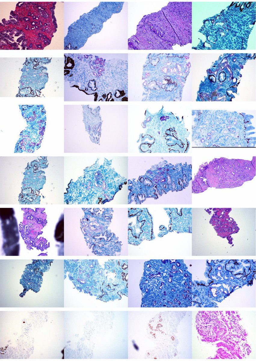 fabiotavora's tweet image. Every time I have a prostate bx with a small focus of 3+3 less than 5%, I include a picture in the report. Here are some from 2018 #uropathology #gupath #iamapathologist