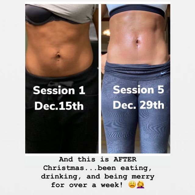 EliteHydration's tweet photo. #ultrasonicbodycontouring results after 5 sessions.  Use code HERFICIONADO to get 50% off a 12 week session. Book online today. #linkinbio 
#elitehydrationcenter #bodysculpting #weightloss #lookgoodforthesummer #getinshape #hydration #hydratetoelevate #m… https://t.co/fbdTgH6lcT https://t.co/z9DQAYGzwL