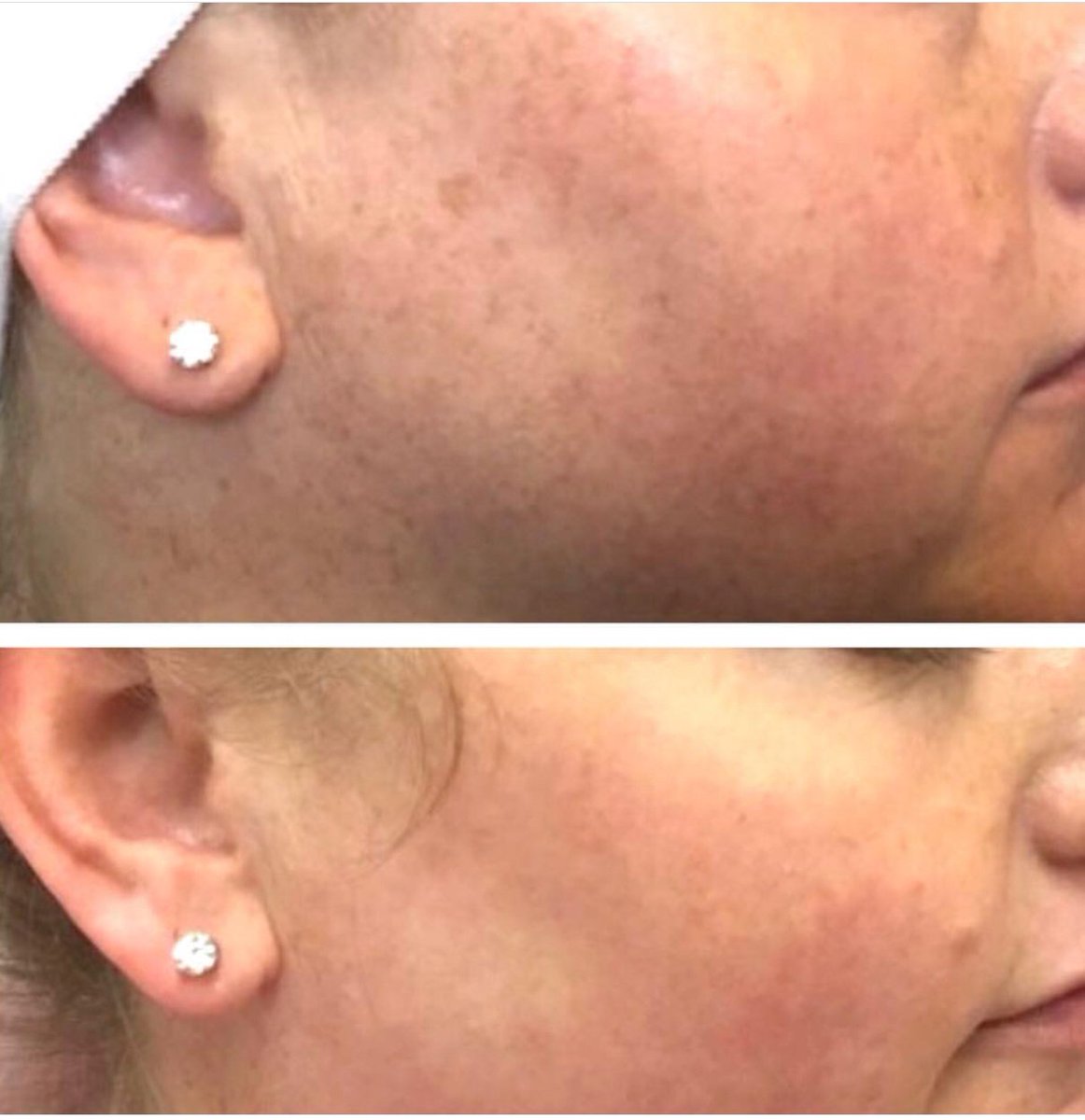 CandelaMedical's tweet photo. It’s never too late to take care of your skin. Here Dr. Jennifer Lee with @RENdermatology is using the SRA applicator with the #elosPlus to treat sun and age spots. https://t.co/VqhFzPRFNW