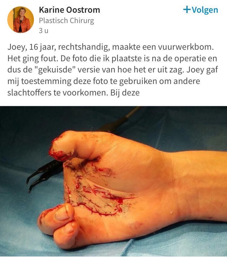 Dit is de ‘gekuisde versie’ van Joey’s rechterhand. Of beter: wat er nog van over is. #vuurwerk (foto gemaakt op 29-12-2016)