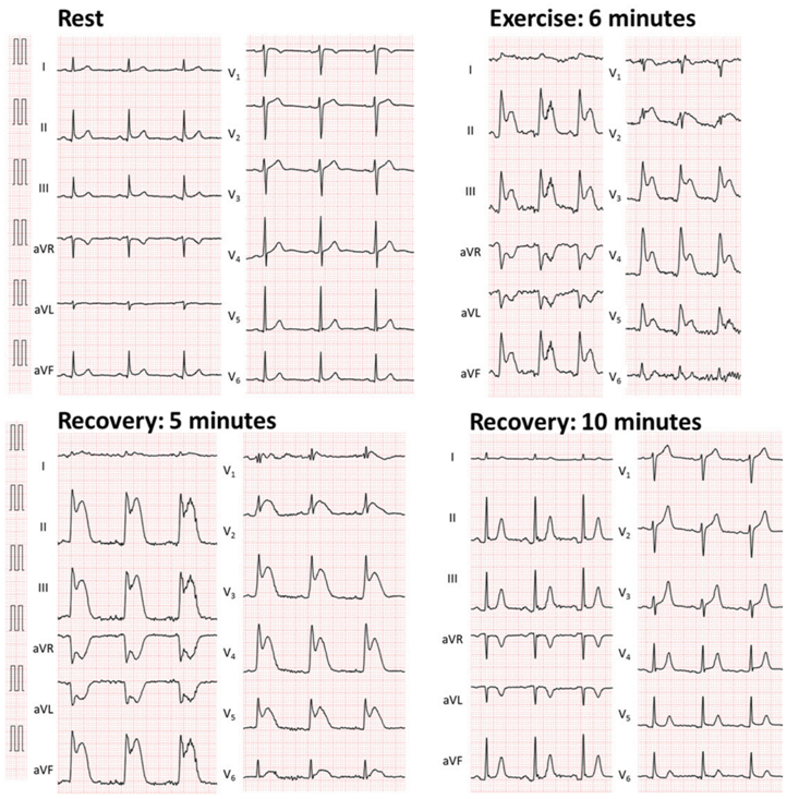 icorvilud's tweet photo. #Exercise induced #vasospastic #angina. #Symptoms arose while riding bycicle....
All images available online: https://t.co/OmHBVRpiq6
Hope he follows advice on #smokingcessation #lifestyle changes
#cardiovascular #riskfactors
#vasomotion #cardiologiadeportiva #sportscardiology https://t.co/l2x5DvL6v1