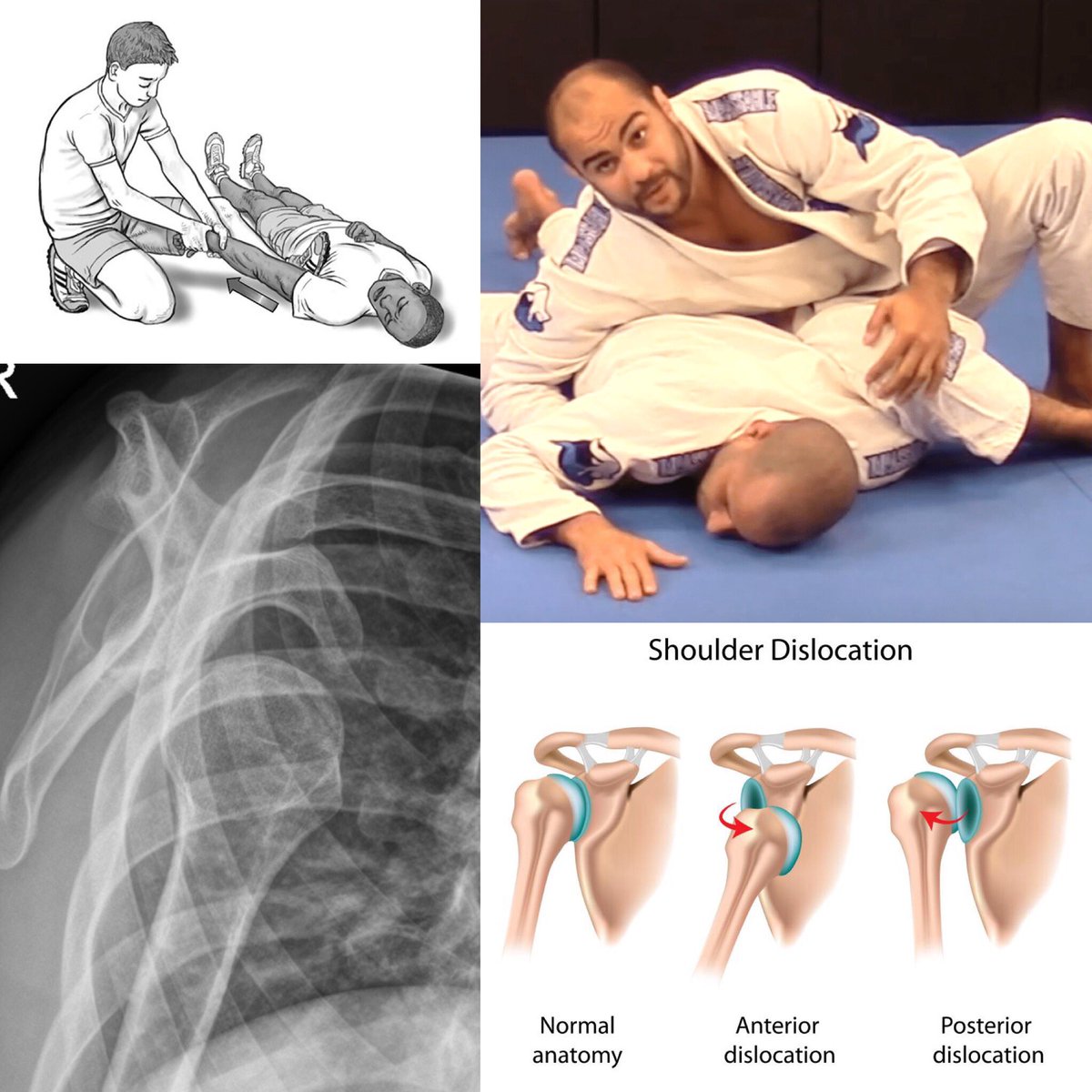medjitsu's tweet photo. Medjitsu Joint series
Part 1.4
Shoulder Dislocation 
⭕️ Dislocation is caused by sudden trauma to the shoulder and hyperabduction forces to the arm from common arm locks. This results in… https://t.co/YjxUDhSvaB… #bjjlifestyle #bjj #MMA2018 #mma #ufc #ibjjf #jiujits4life https://t.co/Zp8X7YHgPh
