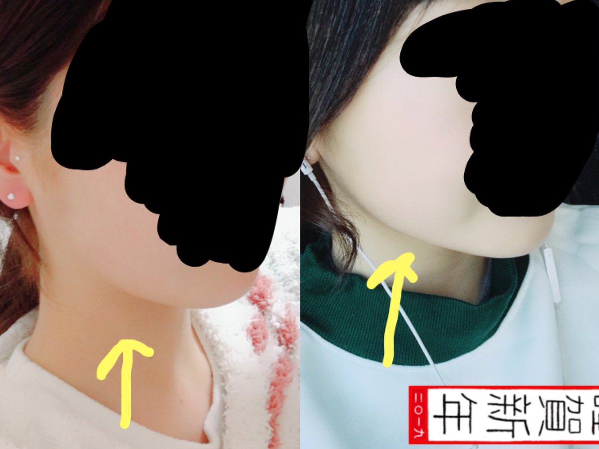 nano_ioi's tweet photo. 2日で顎のラインこんなに変わりました！
気になってる方は、
耳ツボジュエリーで検索！！ https://t.co/nAFbqDdtU2