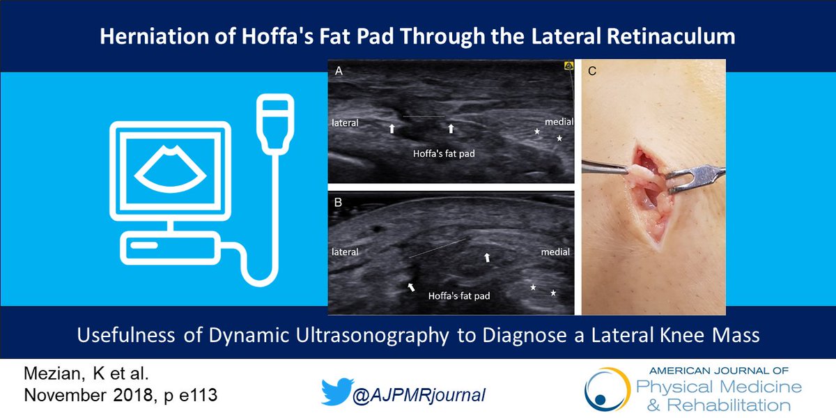 AJPMRjournal's tweet photo. #VisualVignette:  Is Dynamic #Ultrasound useful for investigating a lateral knee mass? #MSKrehab #Physiatry #rehab  https://t.co/n3UP9wWCgg https://t.co/DTw8Gf6wi8