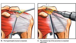 AdamMeakins's tweet photo. Systematic review finds that subacromial decompression surgery provides no benefit when compared to placebo or exercise, and probably carries a small risk of serious harm! https://t.co/tMAxM4NJL0 https://t.co/nYVA6WPOKy