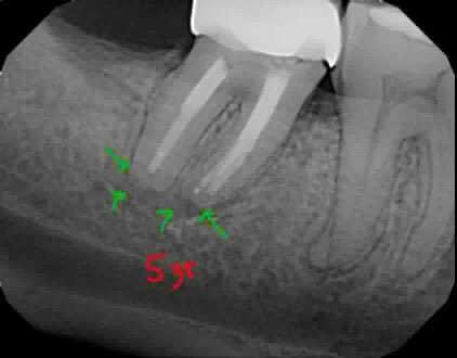 DrRicoShort's tweet photo. The SHORT Case Of The Day!
Tooth #31 ~ Relax or Extract?
It had a previous root canal from India over 5 years ago with a large PAP. I performed a retreatment in 2 visits. Patient returned for a 5 year recall still asymptomatic and very nice bone healing.
#RelaxDontExtract
#Roots https://t.co/CN30SnENwN